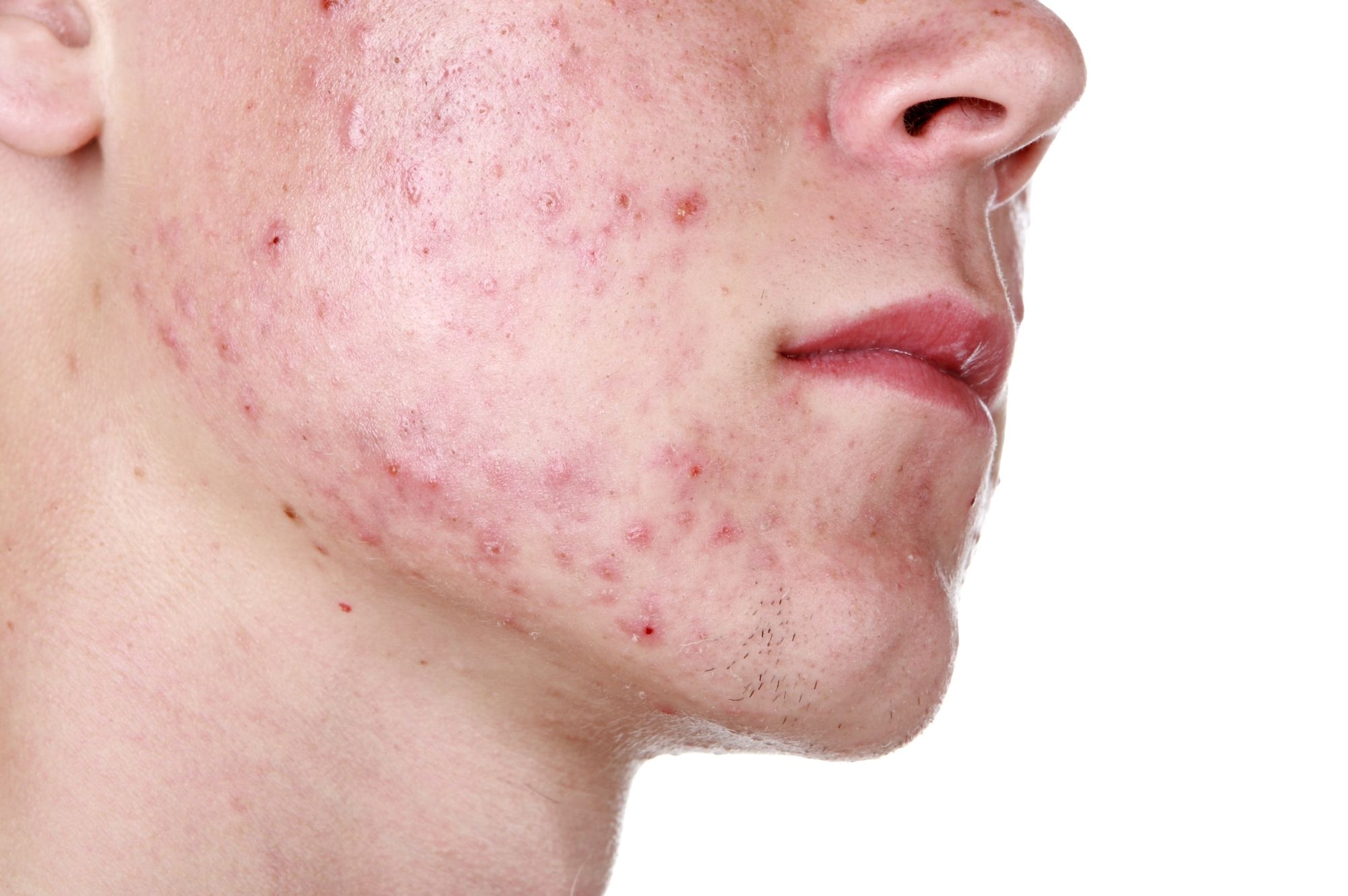 5 misverstanden over acne -