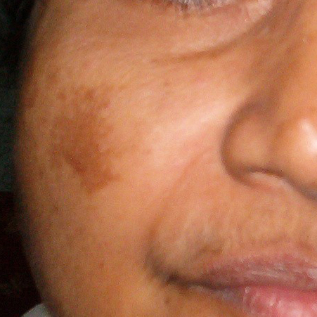 dermatoloog opbleken donkere vlekken in gezicht